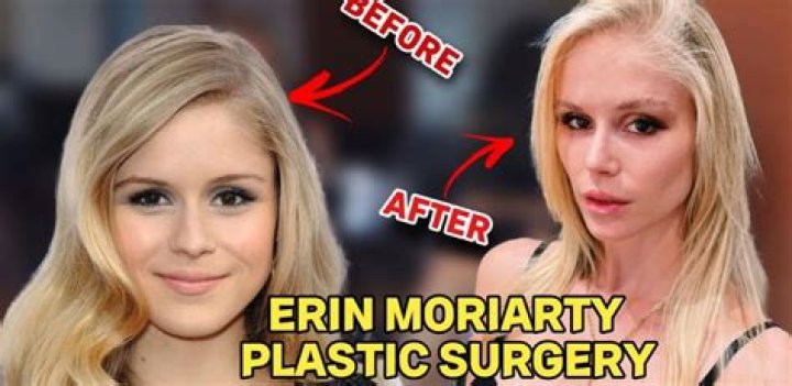 Erin Moriarty Nose Job, Plastic Surgery Before And After