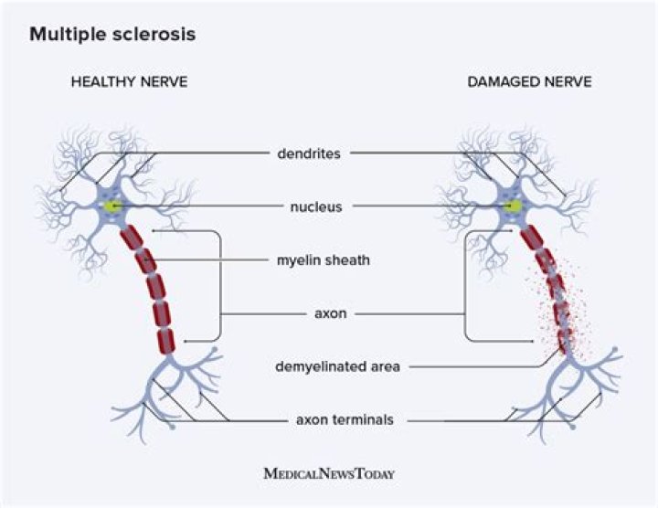 Faith Salie's Journey With Multiple Sclerosis: An In-Depth Exploration