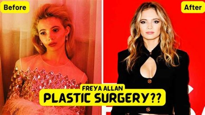 Freya Allan's Plastic Surgery Journey