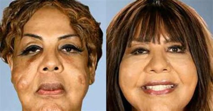 Photos from Botched Patients Before and After: Shocking Transformations! ·