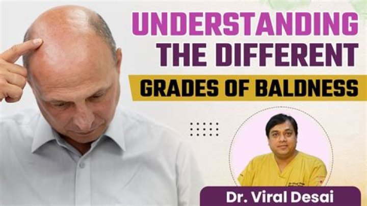 Pierre Gasly's Baldness And Its Impact