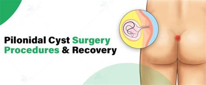 Pilonidal Cyst Surgery Cost - JamBlog