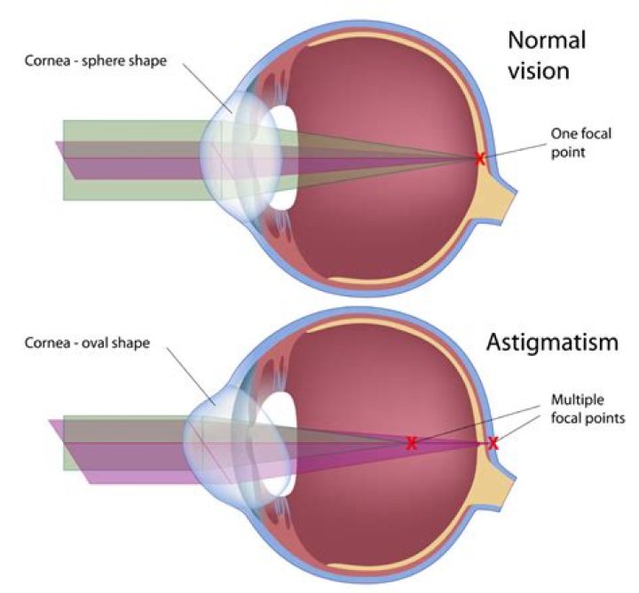 Unveiling The Visual Distortions Of Astigmatism: A Comprehensive Guide